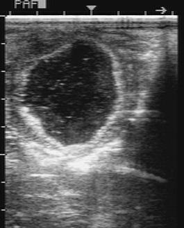 Luteal Type: Initial recognition when multiple echogenic particles noted in follicular lumen on ultrasonography Echogenic particles Hemorrhagic/Luteinized Anovulatory Follicles Potential cause(s):