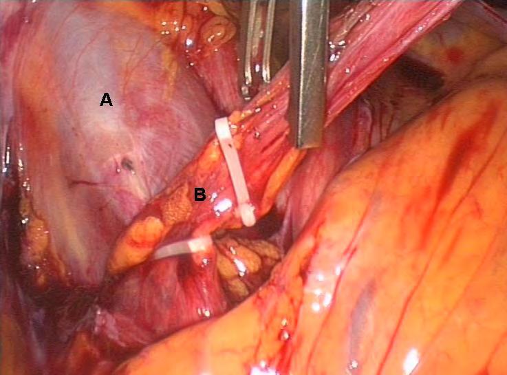 Laparoscopic ovariectomy (Jadoul et al. FS 2007; 87) Description of laparoscopic ovariectomy for whole human ovary. 1.