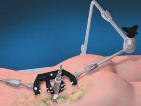 Set-Up of the AccuVision Frame On the Surgical Field Unlock the articulating arm by turning the black star handle counter clockwise, note hold on to the distal portion of the
