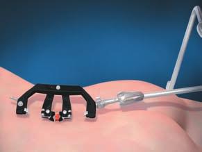 Reduce distraction of the cephalad and caudal blades by engaging the release mechanism and using the hex wrench to