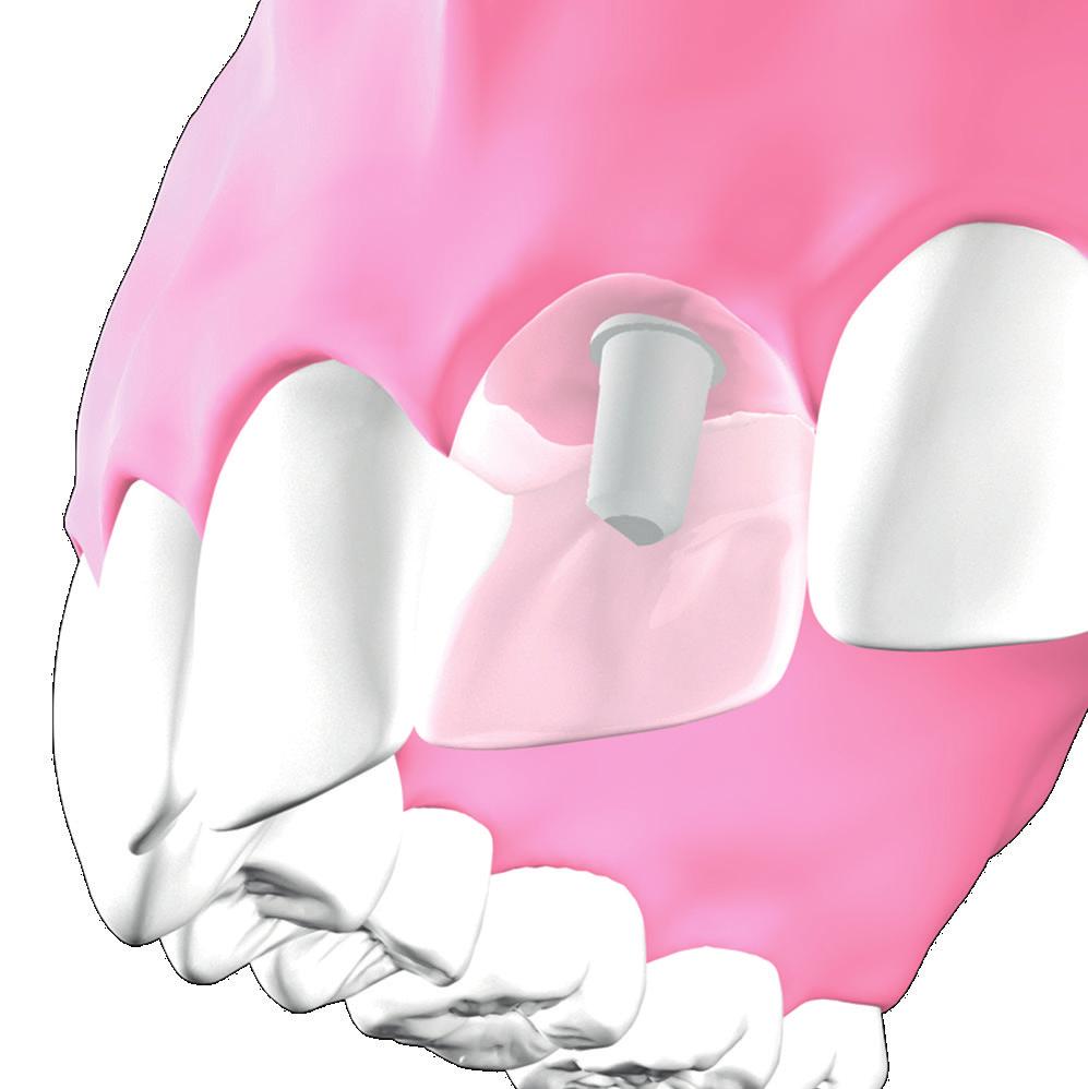 Suitable for individual tooth restoration Fits into gaps in teeth There are many reasons for tooth