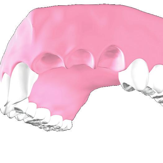 allowing restoration of a continuous row of teeth. Missing teeth must be replaced.
