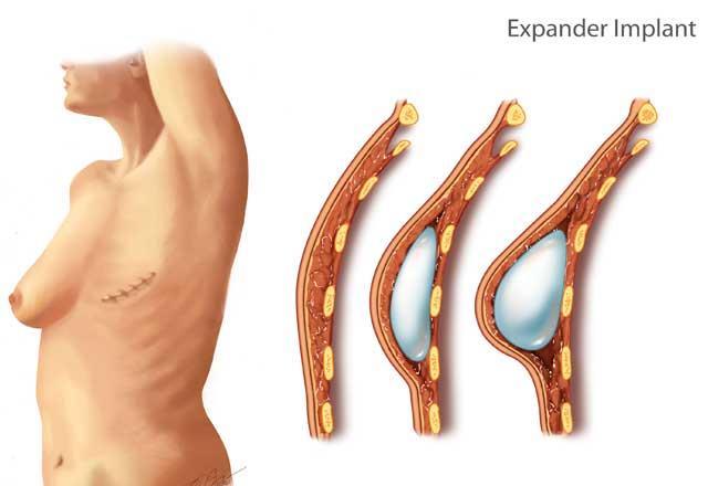Reconstruction options Tissue expander placed at time of mastectomy Most common immediate reconstruction Typically placed underneath the pectoralis muscle Initially only partially filled at time of