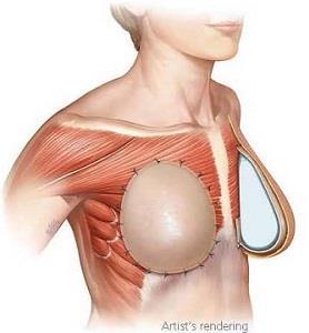 Pre-pectoral expanders/implants Plastic surgeons are starting to place tissue expanders/implants above the pectoralis