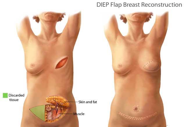 Reconstruction using your own tissue DIEP flap using skin and soft tissue from the abdomen most commonly performed here Typically not performed at