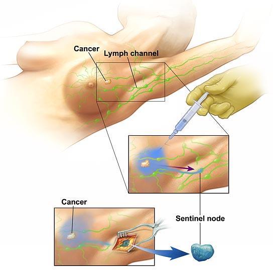 Sentinel lymph node biopsy The sentinel lymph nodes are the first lymph nodes to drain the breast tissue If breast cancer has spread, it will go here first If the sentinel nodes are negative, can
