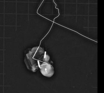 palpable Aim to remove 3 sentinel nodes and the clipped node targeted axillary dissection If sentinel