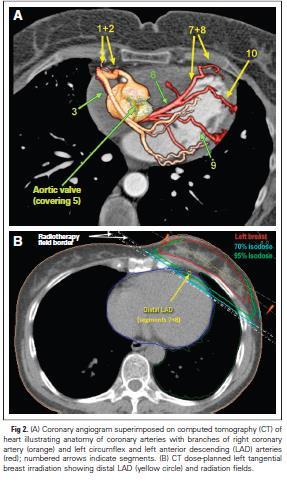 Impact of Radiation on coronary artery stenosis Goal is no Radiation exposure to