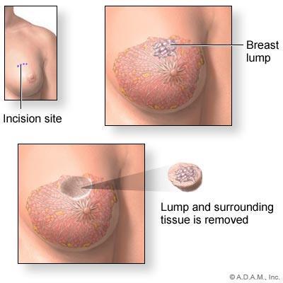 Lumpectomy Wide excision of the area containing DCIS or invasive cancer Survival is the same for lumpectomy plus radiation vs.