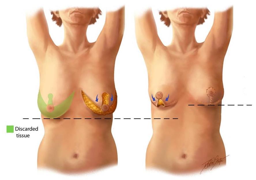 Lumpectomy with oncoplastic reduction/rearrangement Ideal candidates Patients who prefer lumpectomy but would require removal of a large amount of tissue Women with larger breasts who desire breast