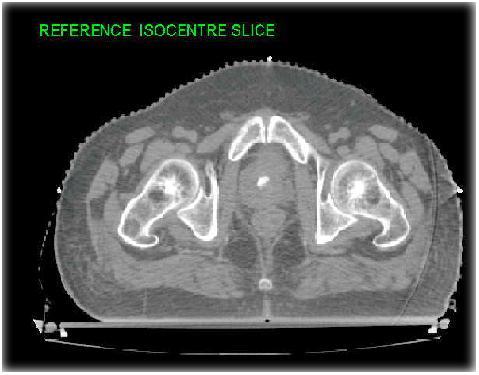 CT Simulation Whole Pelvis Slice thickness 3mm Patient aligned to the fiducials & laser marks