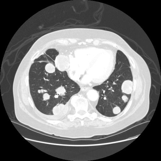 AC Post-partum CR breast, nodes, lung with ICb + E lumpectomy and radiation + continued E 2 years later resection of solitary recurrent lung metastasis -- very low expression PTEN 6 cycles ICb + E