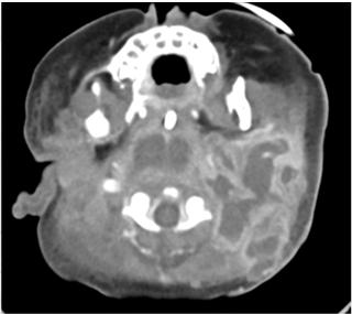 Retropharyngeal Abscess: Radiographically Retropharyngeal Abscess: