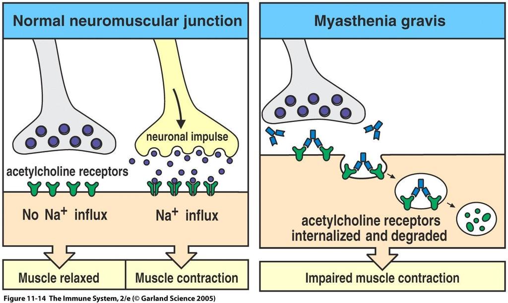 Myasthenia Gravis Abs bind to the Ach receptor on muscle cells, resulting in their endocytosis and degradation Results in loss