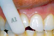 Special Shades For an anterior cavity, choose the Special shade to go underneath the Standard Shade. Special shades have a higher opacity (i.e. lower translucency) than standard shades and are used