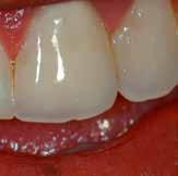 tooth structure also brings into play other optical properties, such as translucency, opalescence and fluorescence.