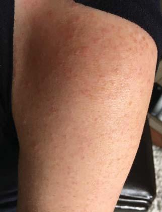 arrived in US from India on 2/19; suspected to have measles