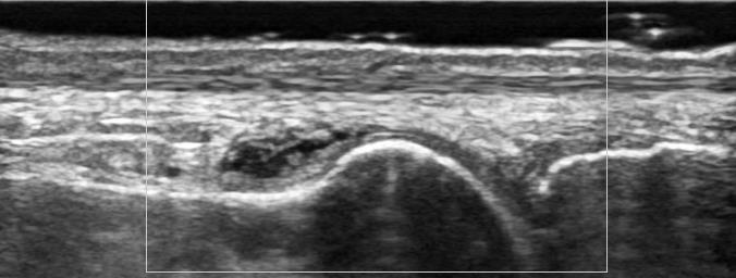 I-A-1) Non-specific thickening of synovial membrane Grayscale Metatarsal Power Doppler Dorsal aspect of