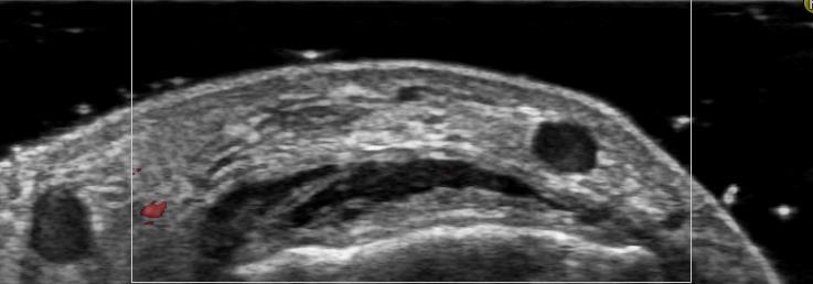 I-A-1) Non-specific thickening of synovial membrane Grayscale Metatarsal Power Doppler Dorsal aspect of