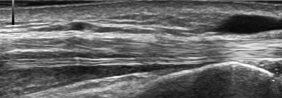 I-B-7) Muscle Vein Without flexion Radius Vein With flexion