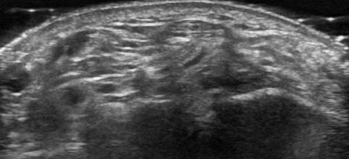 II-A Intra-articular normal vessels Grayscale Trapezoid Capitate Power Doppler Dorsal aspect of