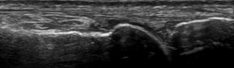 indicate non-specific thickening of synovial membrane (see also Video 1)