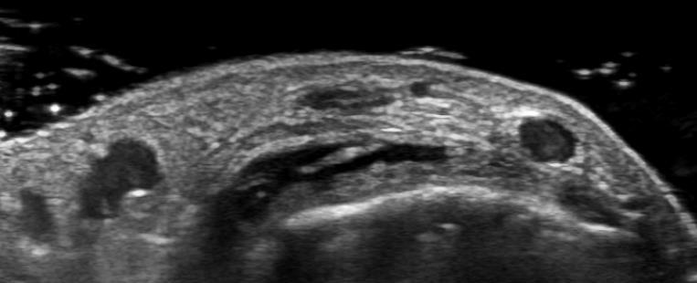 Dorsal aspect of metatarsophalangeal joint in right 1 st toe, transverse
