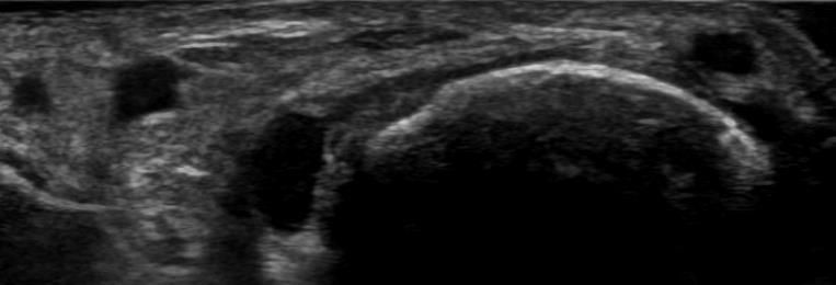 non-specific thickening of synovial membrane (see also Video 2) I-A-1)