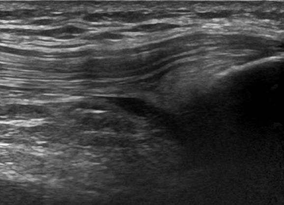 I-A-2) Non-specific accumulation of synovial