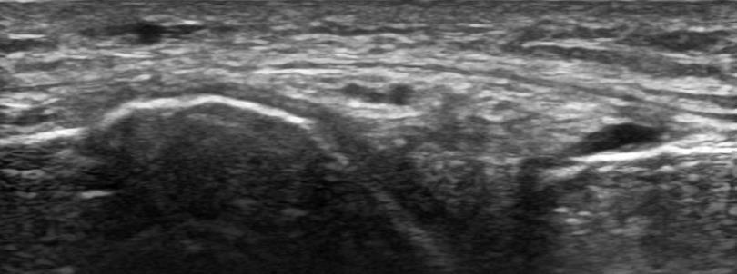 accumulation of synovial fluid (see also Video 3) I-A-2)
