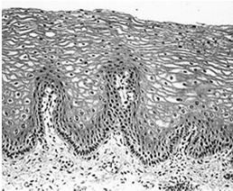 Regeneration of squamous epithelium Columnar metaplasia GERD Reflux