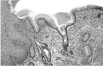 Barrett s Esophagus Goblet Cells Intestinal Metaplasia No