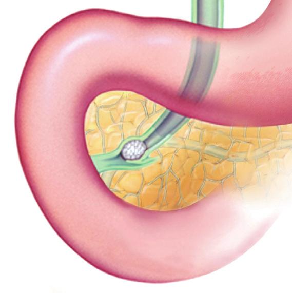 Gallstone blocking the cystic duct Inflamed, tender gallbladder Stomach Gallstones Common bile duct Duodenum Ampulla Pancreas Pancreatic duct Pain caused by