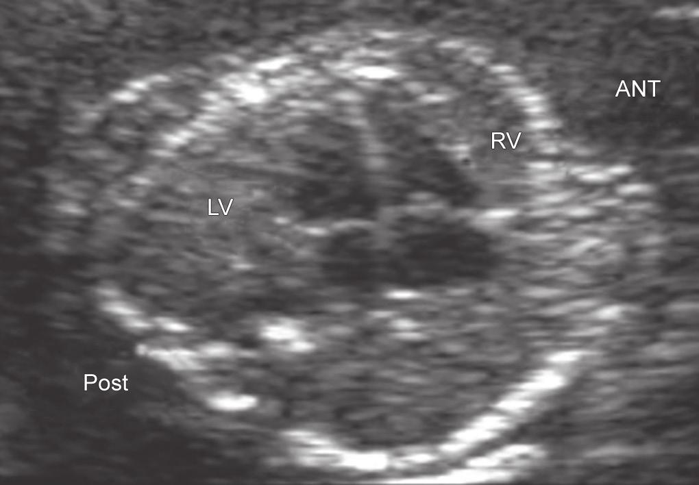 2: Four-chamber view showing both ventricles on equal size, intact septum, moderator band seen in the right ventricle, and different