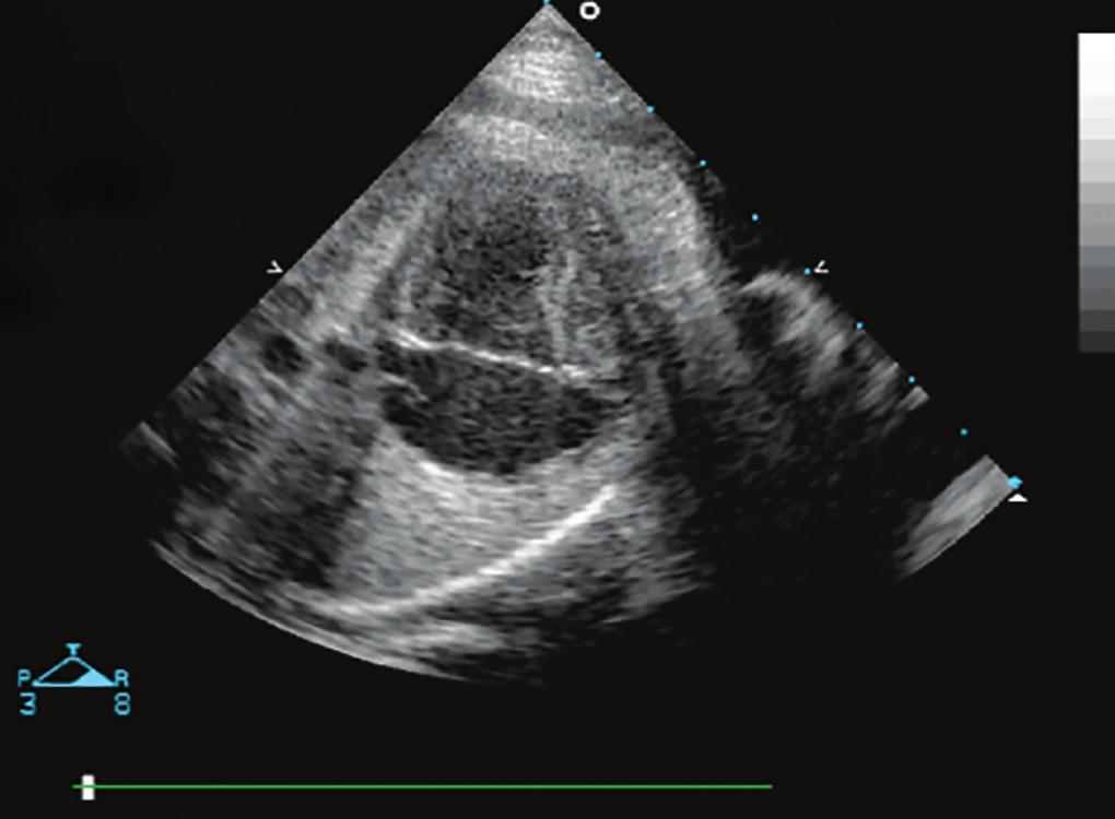 DISCUSSION When we examine the fetal heart during anomaly scan, we aim to screen for any critical congenital heart defect which may affect the life of the newborn.