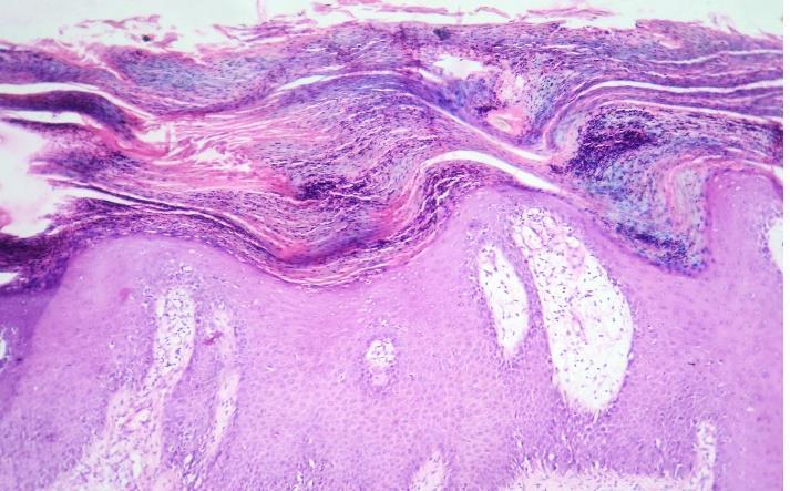 Figure 3: Photomicrograph of Psoriasis vulgaris showing acanthosis, parakeratosis, elongated rete ridges, suprapapillary thickening, Munro microabscesses, hypogranulosis, dilated dermal capillaris,