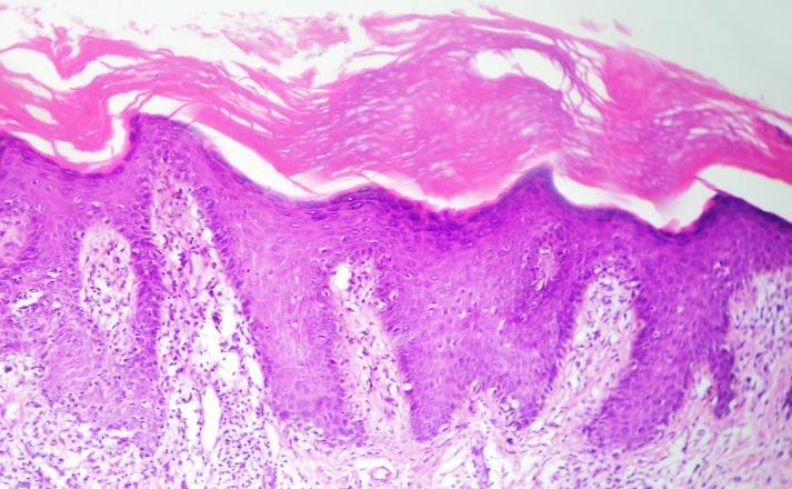 On histopathological examination, both the cases of lichen striatus showed hyperkeratosis, focal parakeratosis, focal spongiosis with exocytosis of lymphocytes, slight acanthosis, periadnexal and