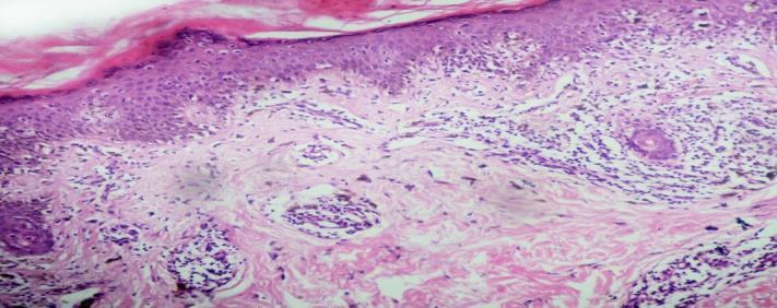 One case which had clinical diagnosis of lichen striatus turned out to be lichen planus histologically.