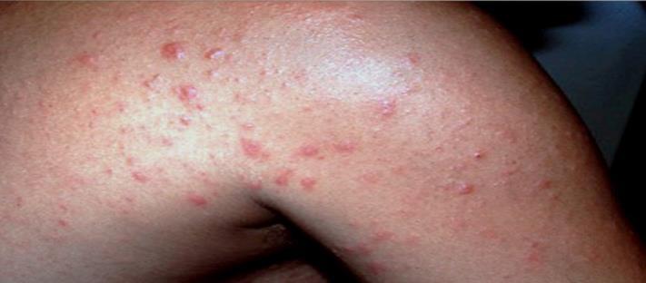 Thus, out of 60 cases of papulosquamous disorders of the skin, we noted positive correlation in 54 (90%) cases i.e., 40 cases of psoriasis, 10 cases of lichen planus, two cases of Pityriasis rubra pilaris and two cases of Pityriasis rosea.