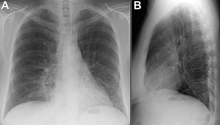 3. The thoracic CT shows multiple non-specific small nodular opacities and basal peribronchial infiltration and bronchiectasis While several nodules are present on the thoracic CT, the nodules are