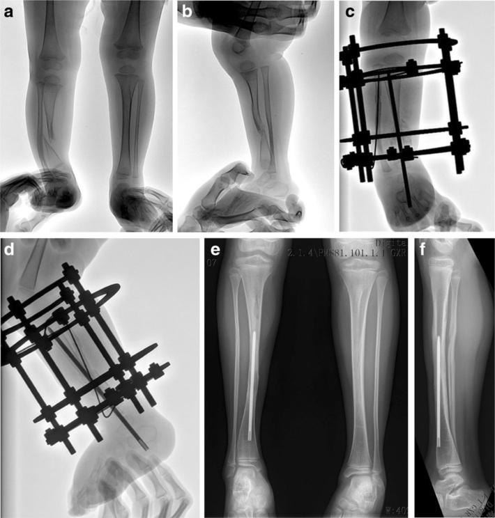 Zhu et al. BMC Musculoskeletal Disorders (2016) 17:443 Page 6 of 8 Fig. 4 A typical case of 2.5 years boy with congenital pseudarthrosis of the tibia.