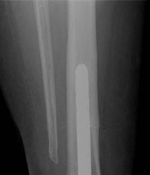 Belczyk, Sung, Wuckich Figure 1b Case 1: Lateral ankle radiographs showing placement of intramedullary nail for the tibiotalocalcaneal arthrodesis.
