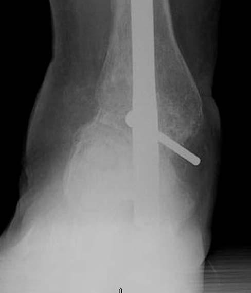 He related a history of a talus fracture that went on to Charcot neuroarthropathy of the ankle and hindfoot.