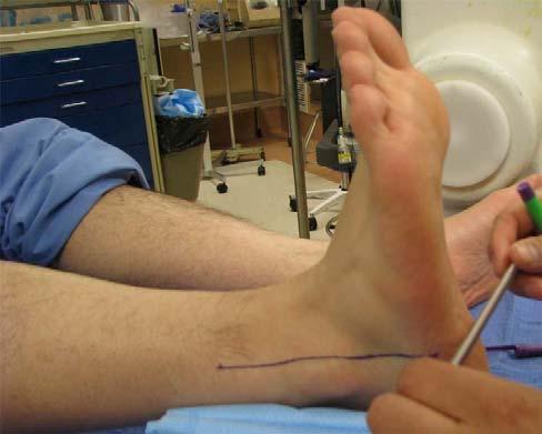 the plantar aspect of the foot along the