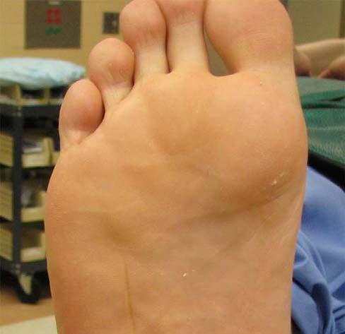 Belczyk, Sung, Wuckich Figure 6 Using image intensification, a calcaneal axial view is taken and a line bisecting the calcaneus is then marked on the plantar skin.