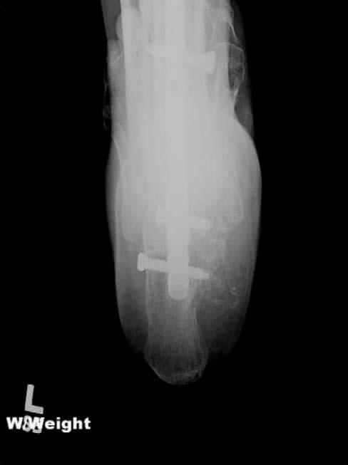 Determining the Insertion Site for Retrograde Intramedullary Nail Fixation of Tibiotalocalcaneal Arthrodesis: A Radiographic and Intraoperative Landmark Analysis.