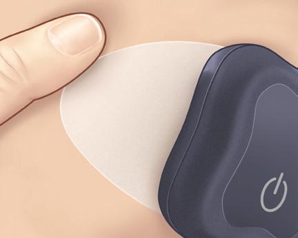 the sensor and smart transmitter. 5. Press the adhesive patch firmly on skin surface over the sensor.