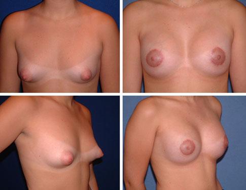 Aesth Plast Surg (2012) 36:331 338 335 Fig. 2 A 19-year-old girl with tuberous breasts who requested breast augmentation. Left row: preoperative photos. Right row: postoperative photos.
