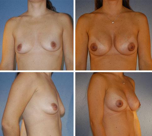 336 Aesth Plast Surg (2012) 36:331 338 Fig. 4 A 28-year-old woman who requested breast enhancement. Left row: preoperative photos. Right row: postoperative photos.