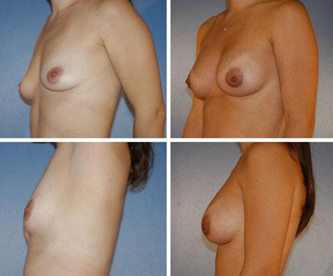 The postoperative photos were taken 1 year after the procedure Fig. 6 A 34-year-old woman who requested breast augmentation. Left row: preoperative photos. Right row: postoperative photos.